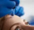 Microneedling